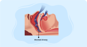 Central Sleep Apnea Syndromes management with blocked airway