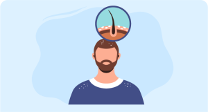 how to treat and prevent dandruff