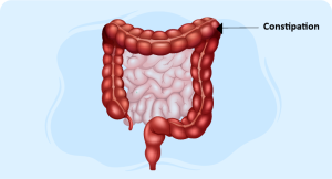 intestine symbolizing constipation relief strategies