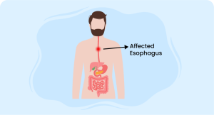 man with affected esophagus related to esophageal hematoma symptoms and diagnosis.