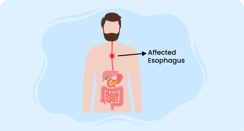 man with affected esophagus related to esophageal hematoma symptoms and diagnosis.