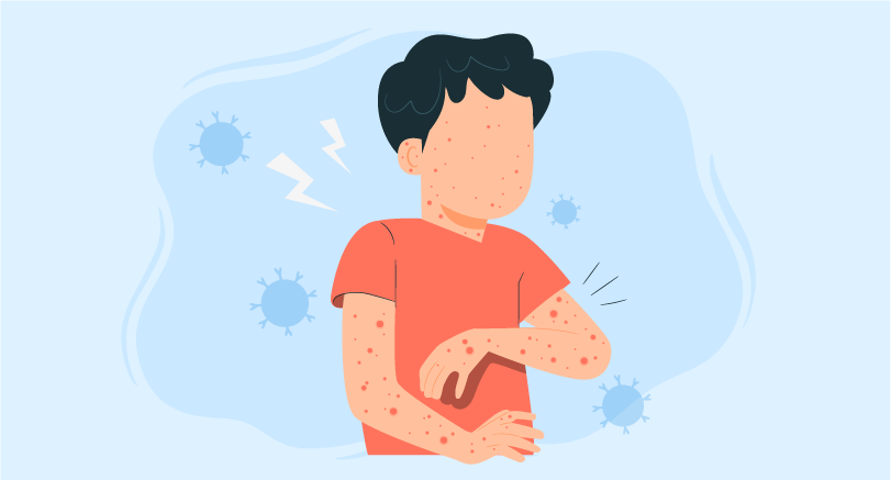 measles management