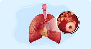 lungs and close up look of center of lungs highlighting COPD care