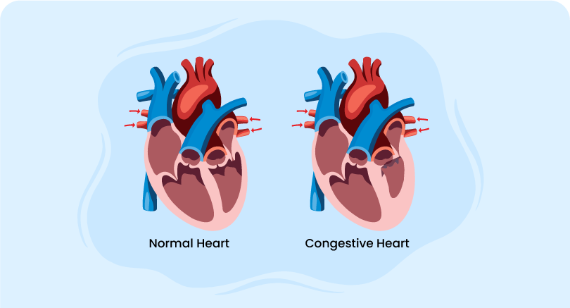 images of normal heart and congestive heart highlighting strategies for Congestive heart failure