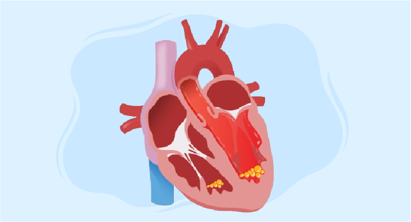 heart and Loeffler Endocarditis course