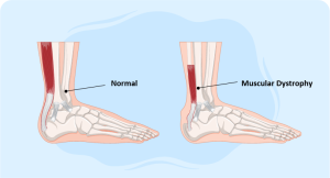 Understanding Muscular Dystrophy