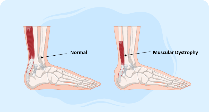 Understanding Muscular Dystrophy
