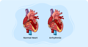 one normal heart and one Arrhythmia heart