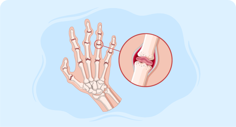illustrating bones of hands and close-up image of finger joint indicating rheumatoid arthritis