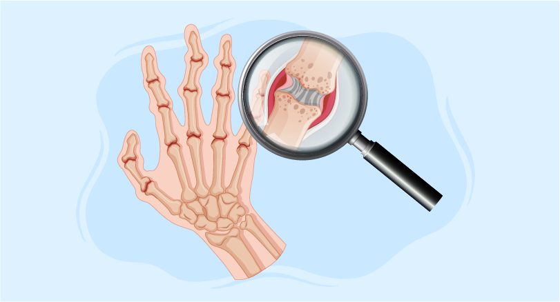 closeup look of bone joints in hands implicating Septic Arthritis