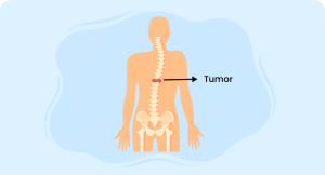 Spinal Tumors metastases