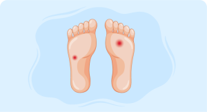 Comprehensive guide to treating neuropathic ulcers