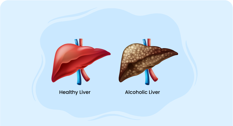healthy liver and alcoholic liver indicating Alcoholic Hepatitis
