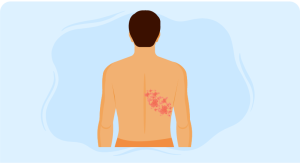 Shingles Course Understanding Herpes Zoster
