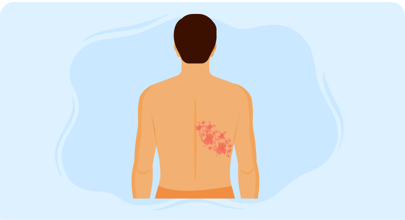 Shingles Course Understanding Herpes Zoster