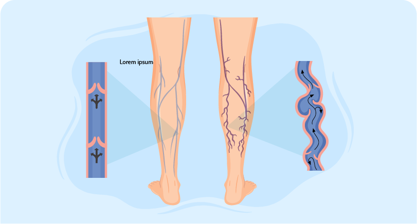 Varicose vein treatment