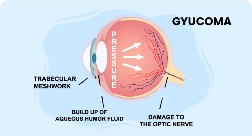 Advances in Primary-Open Angle Glaucoma Treatment