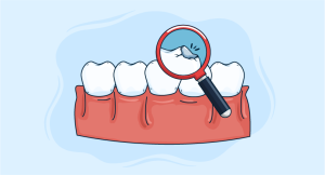 Avulsed tooth management