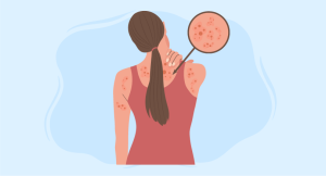 bacillary angiomatosis diagnosis and treatment