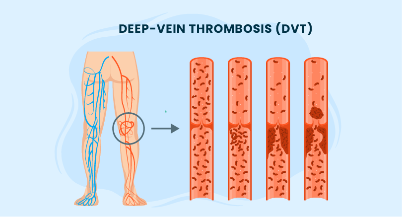 Diagnose DVT with POCUS
