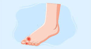 understanding and managing pernio