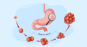 Gastric cancer diagnosis