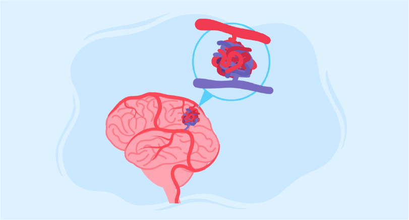 Vein of Galen malformation